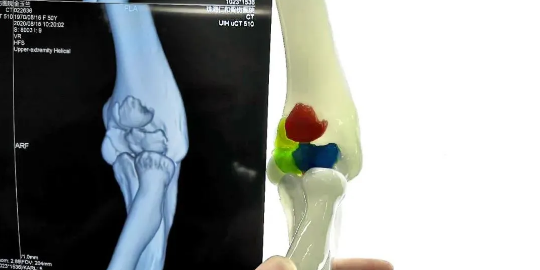 3D打印彩色手术手板模型